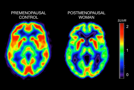 Brain activity pre and post menopause